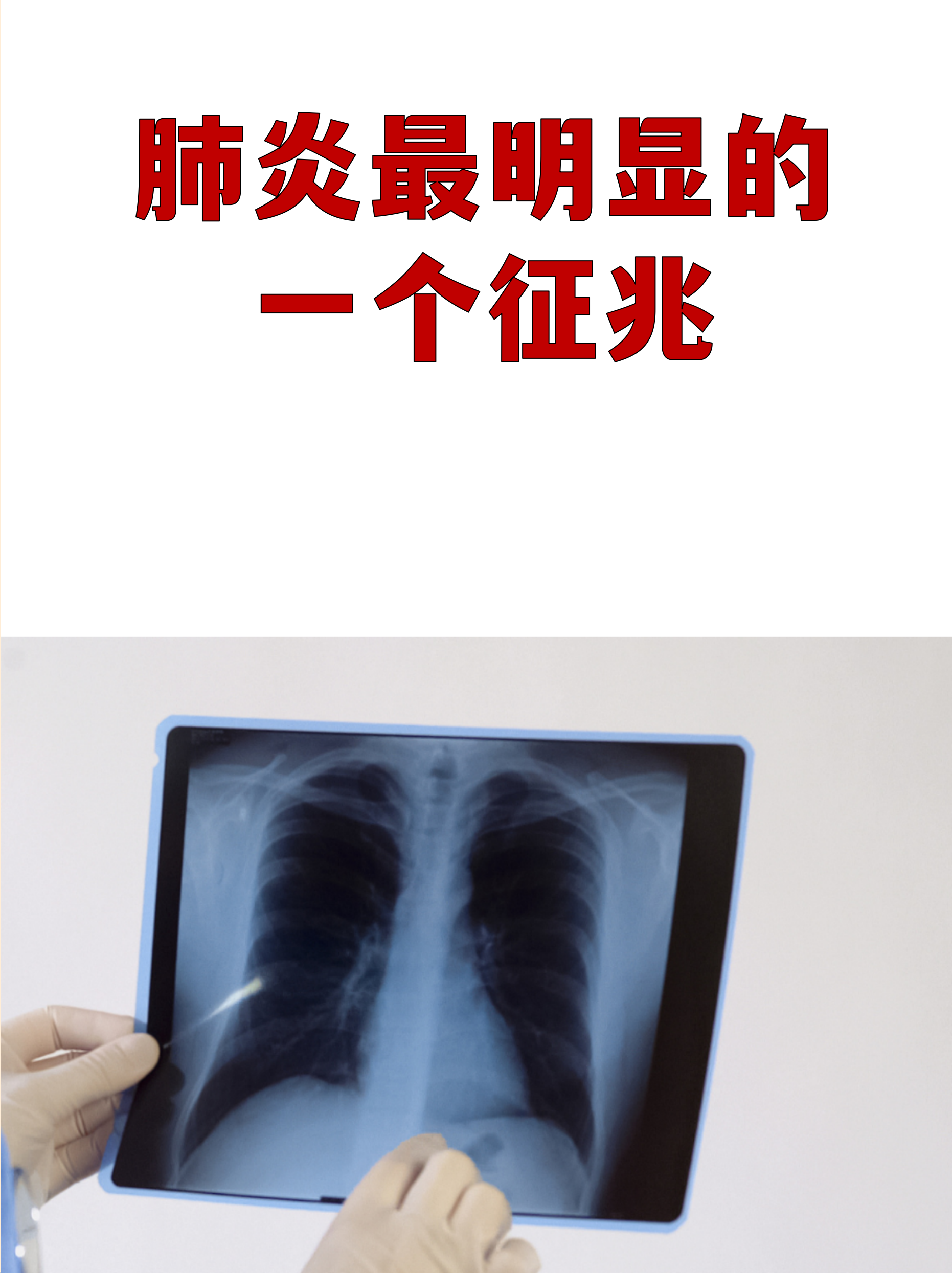 全国肺炎疫情最新消息-全国肺炎最新动态消息-第3张图片