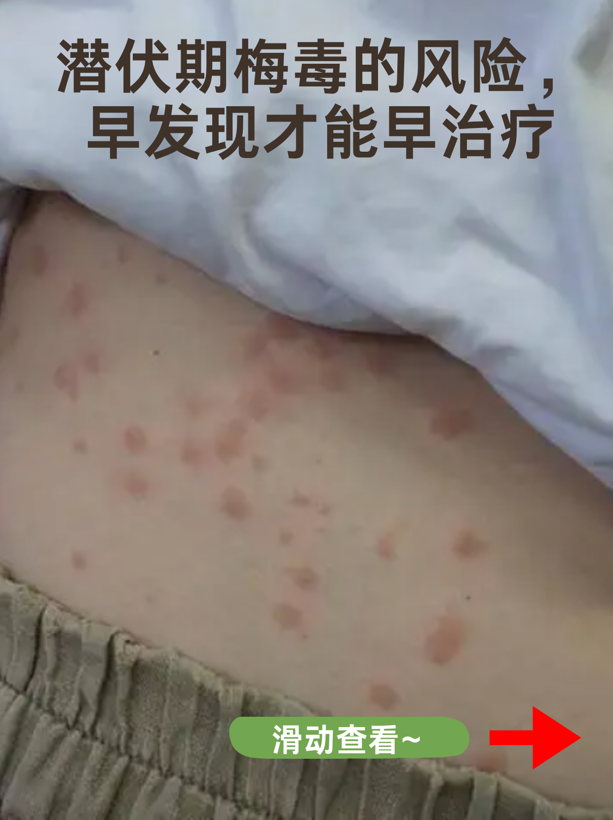 “德尔塔毒株或导致更严重疾病” 德尔塔毒株的临床症状？-第3张图片